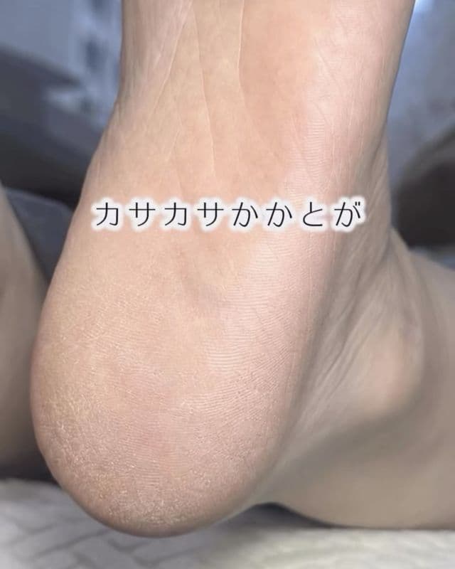 施術前のかかと。乾燥してカサカサとした角質が残っている状態(@nail_kanae のストーリーズより)